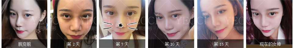 再也不用天天貼了，雙眼皮美美噠