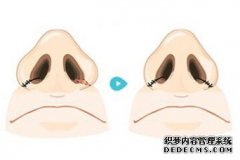 永康假體隆鼻大概需要多少錢